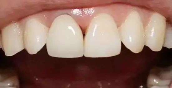 牙缝里为什么会长黑黑的东西？ 